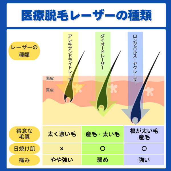 医療脱毛レーザーの種類