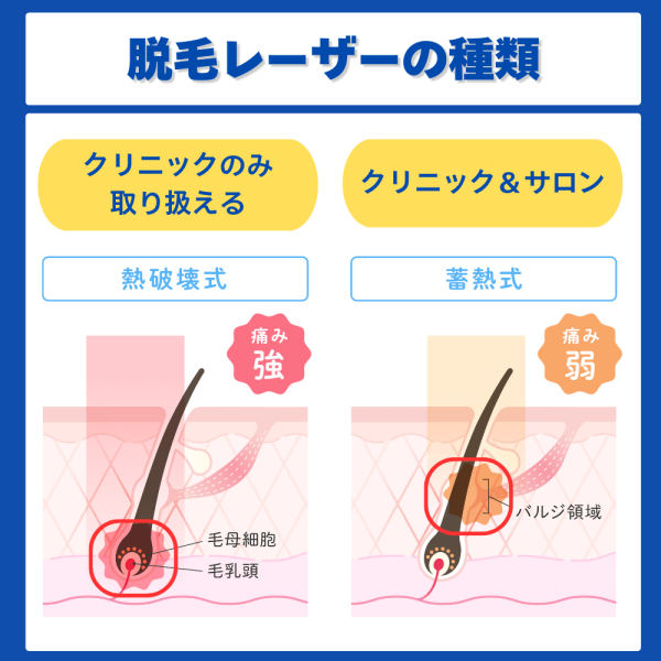 熱破壊式と蓄熱式脱毛機の違い