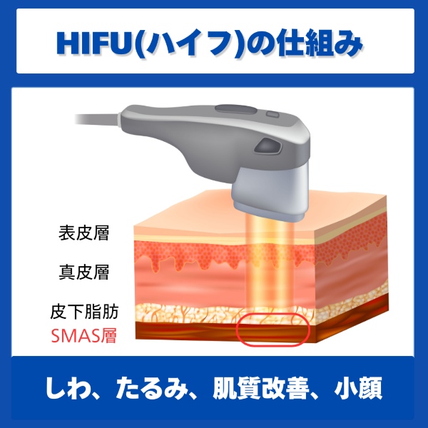 HIFU（ハイフ）の仕組み