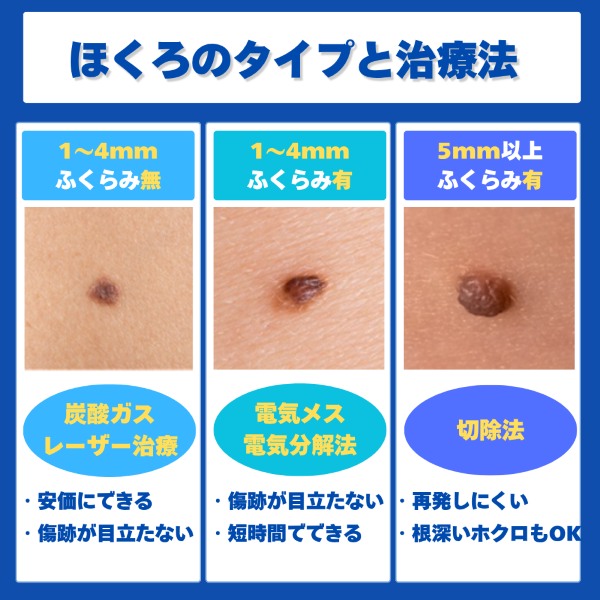 ホクロ除去の方法