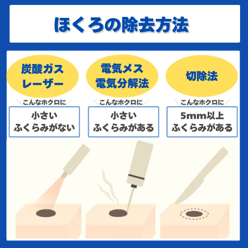 ホクロの除去方法
