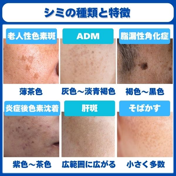 シミの種類と特徴