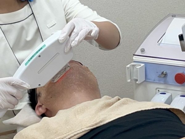 メンズクリア施術